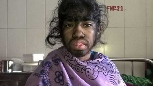 El drama de la nena que padece "síndrome de lobo" en Bangladesh