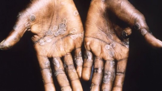 Emergencia global por la viruela del mono: cuántos casos confirmados hay en la Argentina