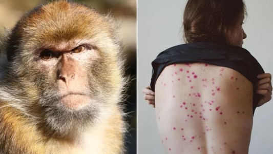 Se registraron siete casos nuevos de viruela del mono, todos en CABA