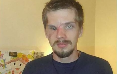 Ucrania: hicieron cirugías estéticas gratuitas a víctimas de la guerra