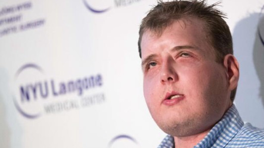 La nueva vida del bombero de Estados Unidos que se sometió a un trasplante de cara