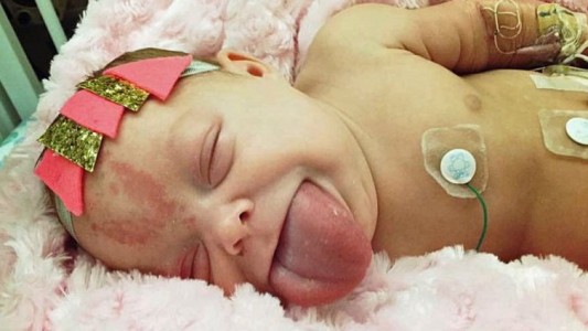 El increíble caso de la bebé que nació con la lengua de un adulto