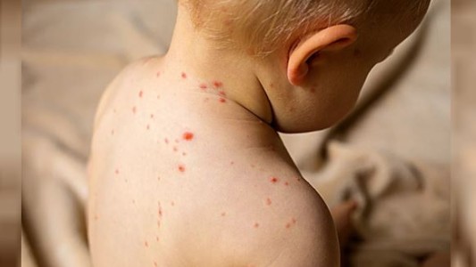 Casos de sarampión: hay alarma en la Ciudad de Buenos Aires y en Provincia