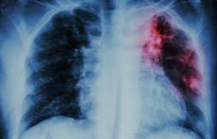 Argentinos desarrollaron un test rápido y de bajo costo para el diagnóstico de la tuberculosis