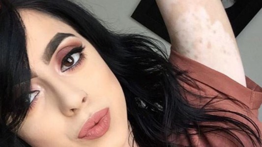 Tiene vitiligo y como respuesta a las burlas convirtió su cuerpo en arte