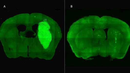 Especialistas del CONICET lograron frenar un tipo de cáncer cerebral con una novedosa estrategia terapéutica