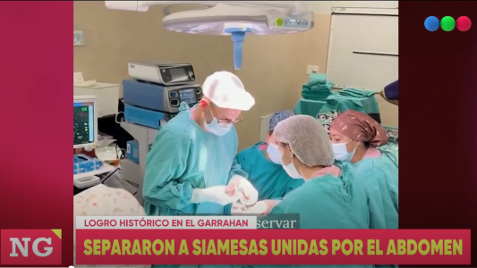 Separaron a dos gemelas siamesas en el Hospital Garrahan