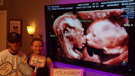 Pura ternura: las gemelas que se dan un beso dentro de la panza de su madre