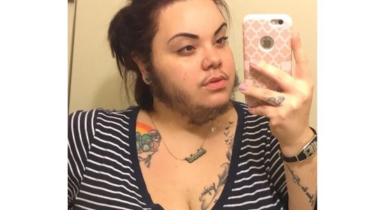 Cansada de los insultos decidió dejarse la barba, producto de un desorden hormonal