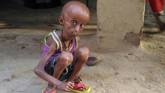 Como Benjamin Button: tiene 21 años y vive atrapado en el cuerpo de un anciano de 160