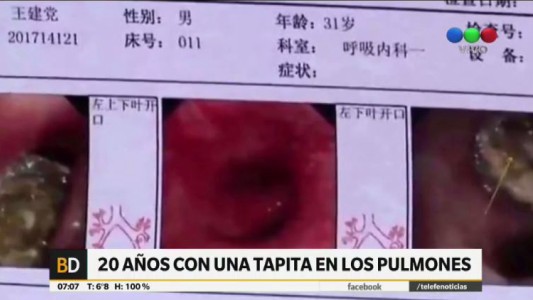 Tosió sangre y descubren una tapita de lapicera que llevaba 20 años en sus pulmones