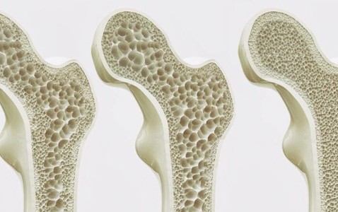 Día Mundial de la Osteoporosis: una de cada tres mujeres mayores de 50 años sufrirá una fractura por osteoporosis