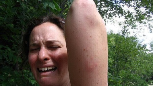 Las cinco razones por las cuales los mosquitos pican a unas personas y a otras no