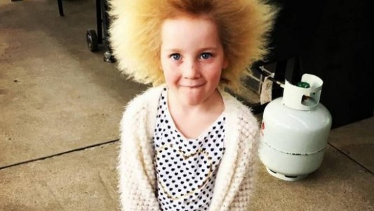 La extraña enfermedad que sufre una nena que no puede peinarse