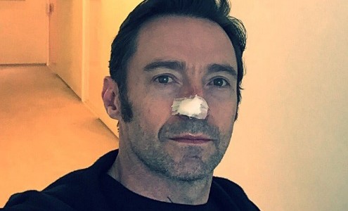 El actor Hugh Jackman se sometió a otro tratamiento contra el cáncer de piel