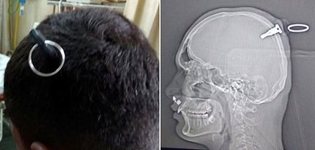 El joven indio que sobrevivió con una llave de cuatro centímetros clavada en la cabeza