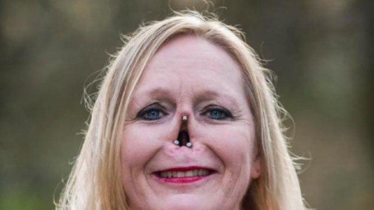 La prótesis magnética que ayuda a vivir a la mujer sin nariz