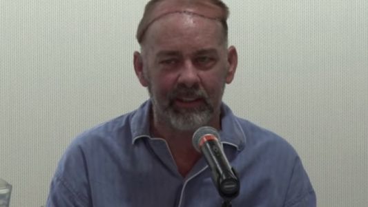 Un hombre recibió el primer trasplante de cráneo y cuero cabelludo