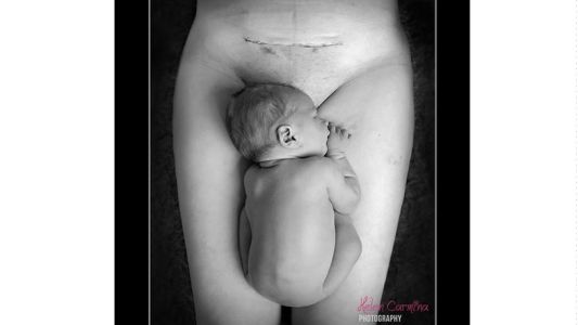 La foto de la cicatriz de una cesárea se vuelve viral