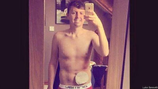 Con 20 años, mostró su bolsa de colostomía en una "selfie" y se volvió viral en la web
