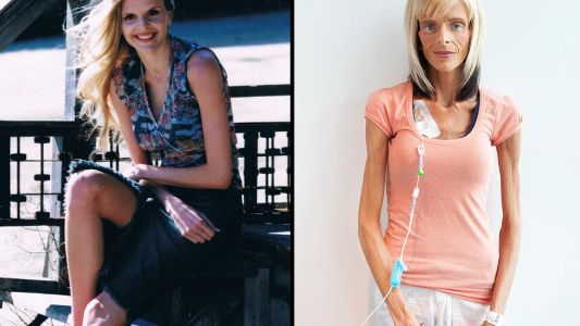 La triste historia de la ex modelo que no puede evitar adelgazar