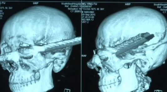 Se recupera luego de que una barra de metal le atravesó la cabeza