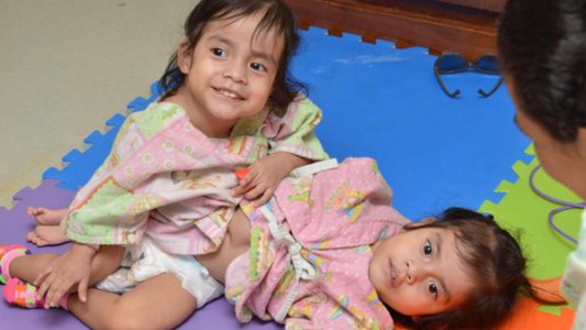 Separaron exitosamente a las "Rositas" las niñas siamesas abandonadas en un hospital de Guatemala