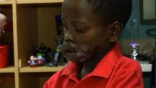 Reconstruyen la cara de un nene que fue atacado por chimpancés