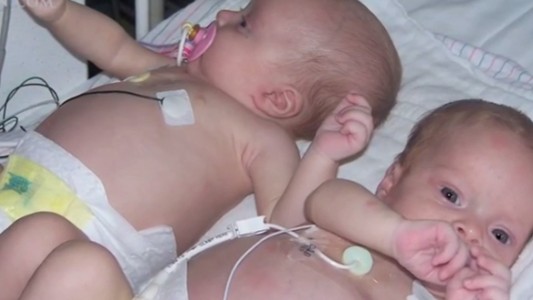 Isabella y Madelein, las gemelas bebés que le ganaron al cáncer