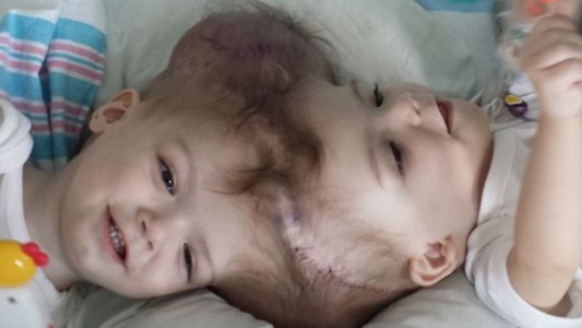 El emocionante momento en que dos siameses separados se ven por primera vez