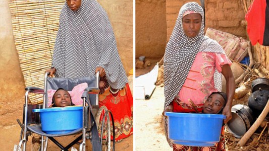 Murió la joven sin cuerpo que vivía en un balde