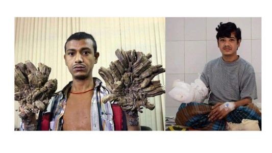 Esperan dar el alta en un mes al "hombre árbol"