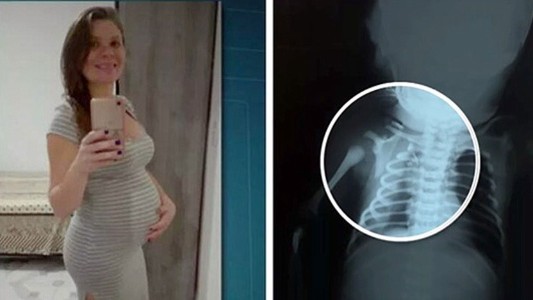 Este bebé fue baleado en el vientre de su mamá y logró sobrevivir