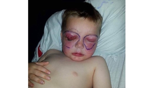 Un niño de cuatro años casi muere en horas al infectarse con la bacteria "come carne"