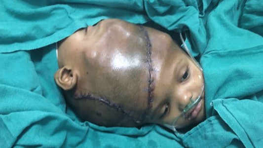 Lograron separar a unos bebés siameses que estaban unidos por la cabeza