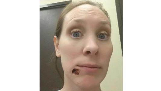 Pensó que era un grano, pero se trataba de un cáncer de piel que le dejó un agujero en la cara