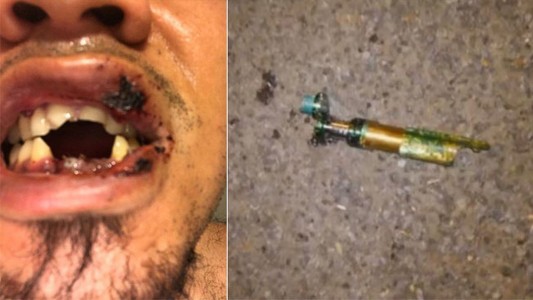 Le explotó un cigarrillo electrónico en la cara y perdió cuatro dientes