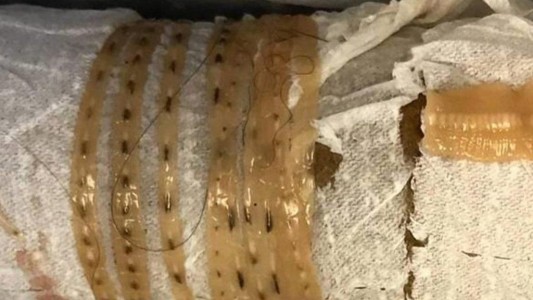 Fue al médico por un dolor de panza y descubrieron que tenía un gusano de un metro y medio en el estómago