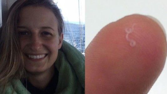 El extraño caso de la mujer que le sacaron 14 gusanos de uno de sus ojos