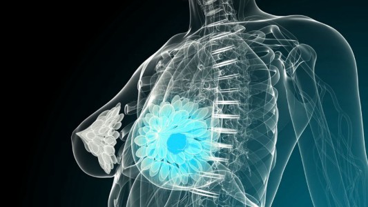 Estados Unidos: consiguen eliminar una metástasis de cáncer de mama por primera vez