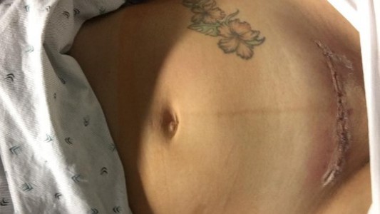 La mujer que se volvió viral por mostrar la cicatriz de su cesárea en Instagram