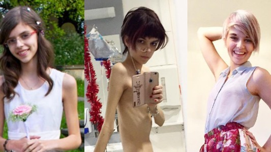 La inspiradora historia de la joven que mostró en fotos cómo superó la anorexia