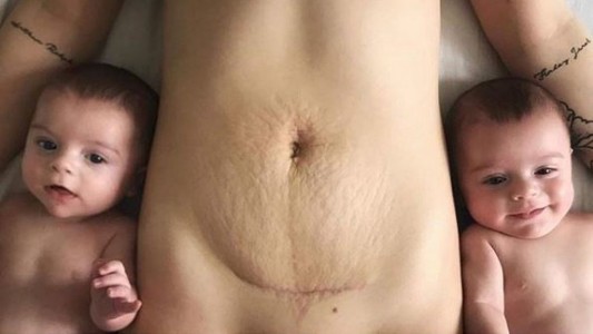La mujer que se hizo viral mostrando con orgullo sus estrías tras dar a luz gemelos