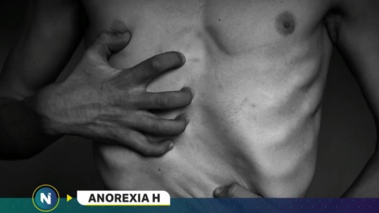 Anorexia H
