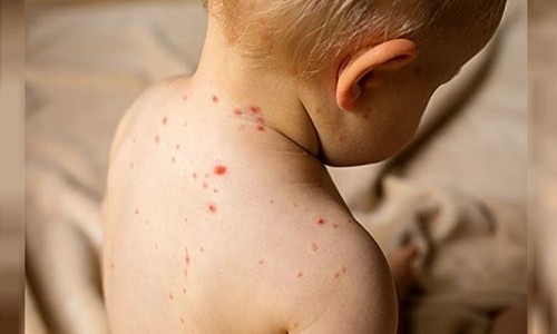 Sarampión: el Ministerio de Salud emitió alerta epidemiológica