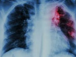 Alerta en Mar del Plata: confirman un caso de tuberculosis en un colegio y activan protocolos sanitarios