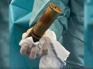 Evacúan hospital en Toulouse por proyectil de la Primera Guerra Mundial alojado en un paciente