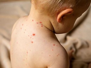 Estados Unidos: más de 250 personas en cuarentena por brote de sarampión en Carolina del Sur